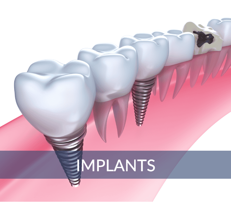 Tooth Implants Services