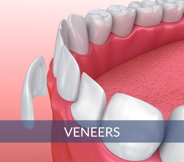 Veneers in Michigan